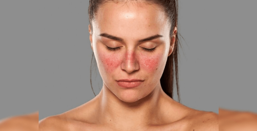 Understanding the outlook for stage 4 lupus