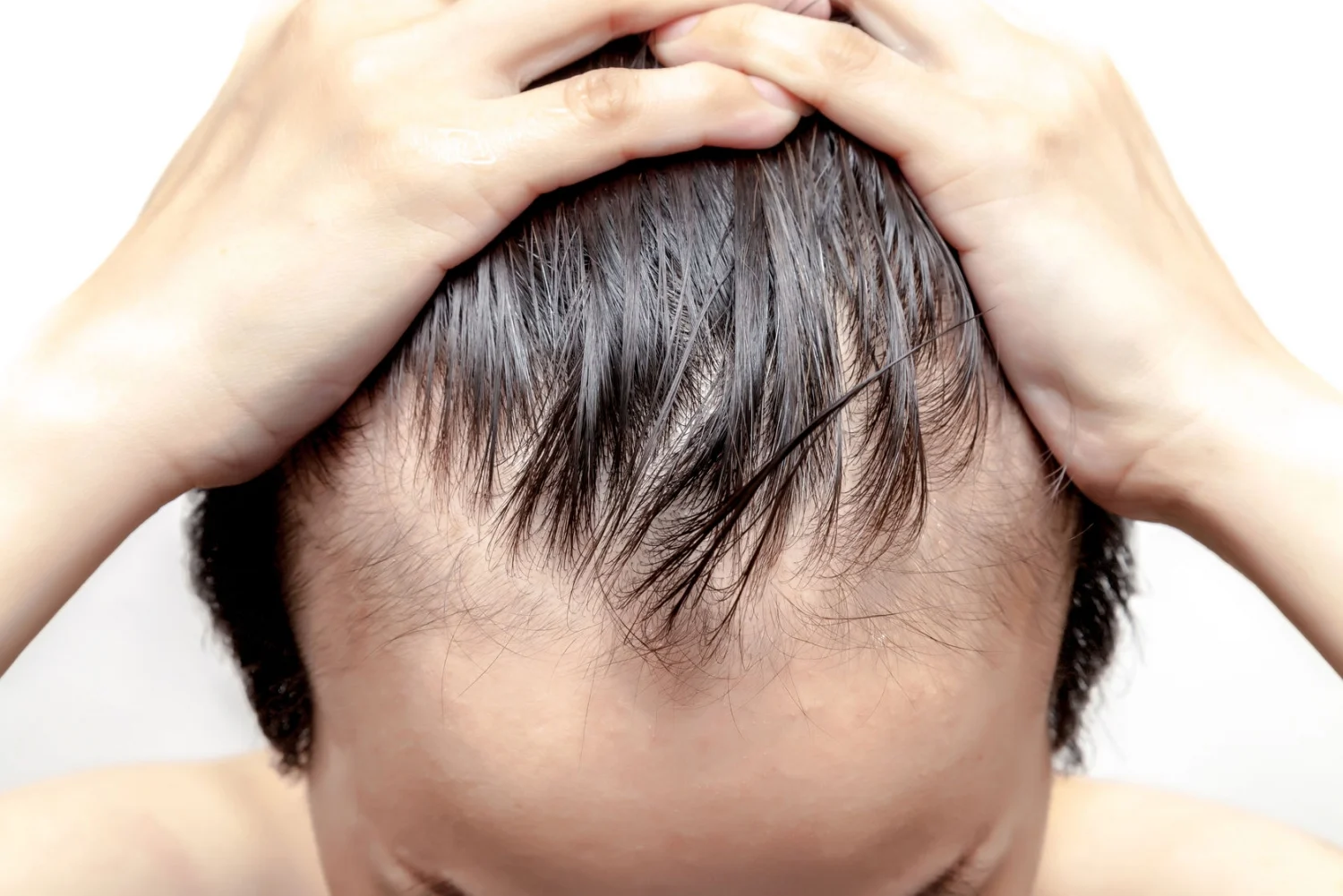 Low potassium and hair loss - kidney health